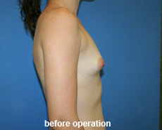 plastic-surgery-breast-augmentation